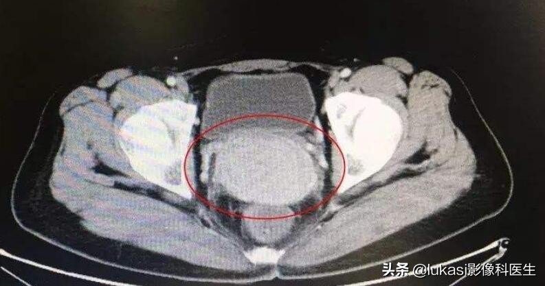 宫颈癌的可怕之处,宫颈癌日益年轻化加强筛查是重点