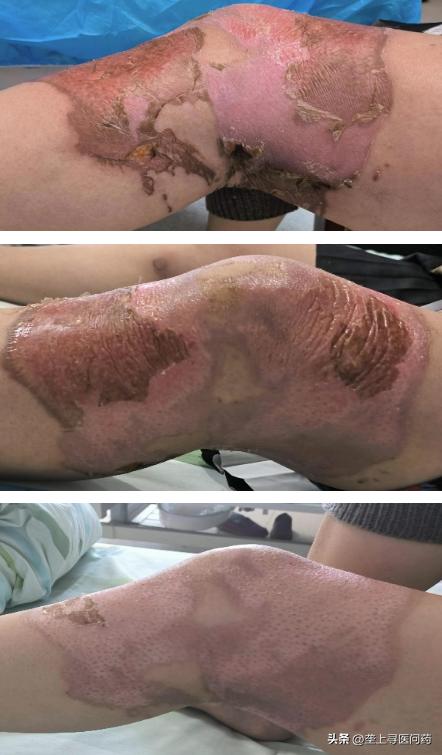 治疗60岁女性腿痛,多年腿疼治疗偏方大全