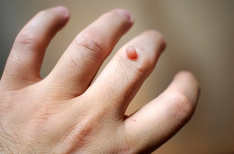 脖子腋下长小肉粒可以用手揪掉吗,脖子旁边出现小肉粒能直接揪掉吗