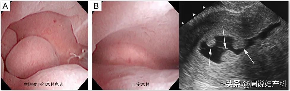 子宫里为什么会长息肉,需要手术吗?