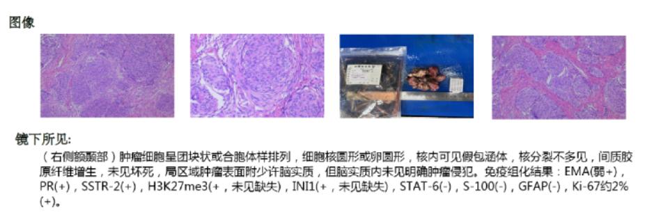 脑肿瘤单眼视力下降,老年人视力下降眼下有黄斑