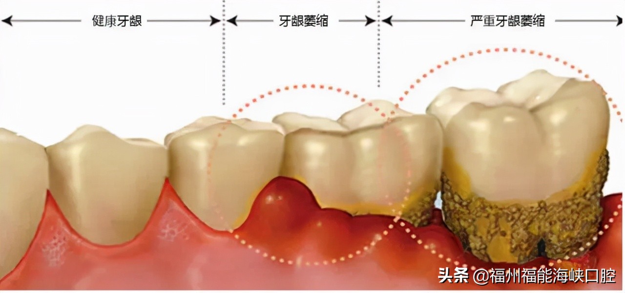 60岁老人牙龈萎缩牙齿松动怎么办,30多岁牙龈萎缩牙齿松动怎么回事