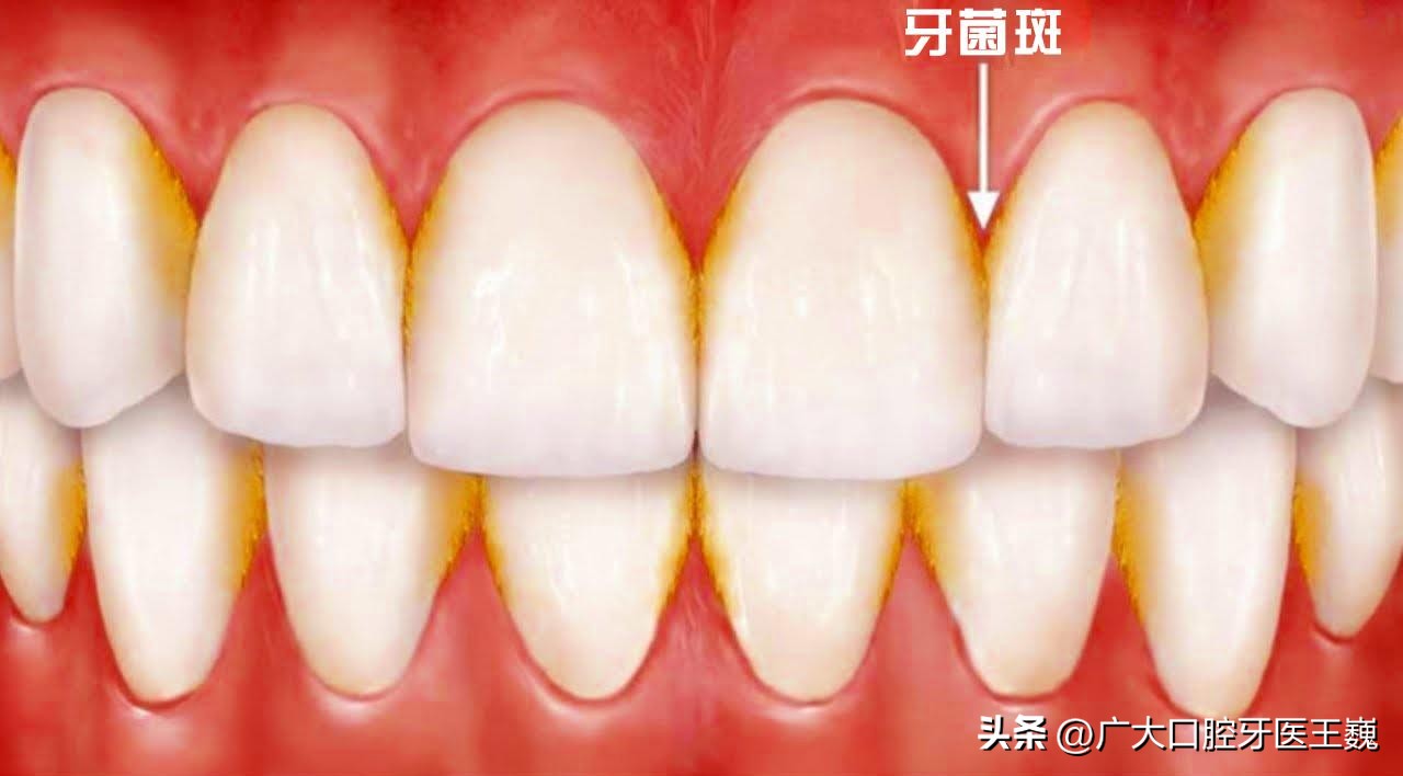 牙齿老是发黄有牙渍怎么办,牙齿里面根部黄渍去除小妙招