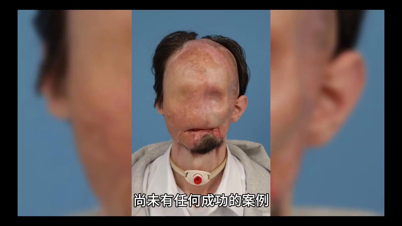 猴头移植成功，标志着医科进展神速#人的生命有望再继续#