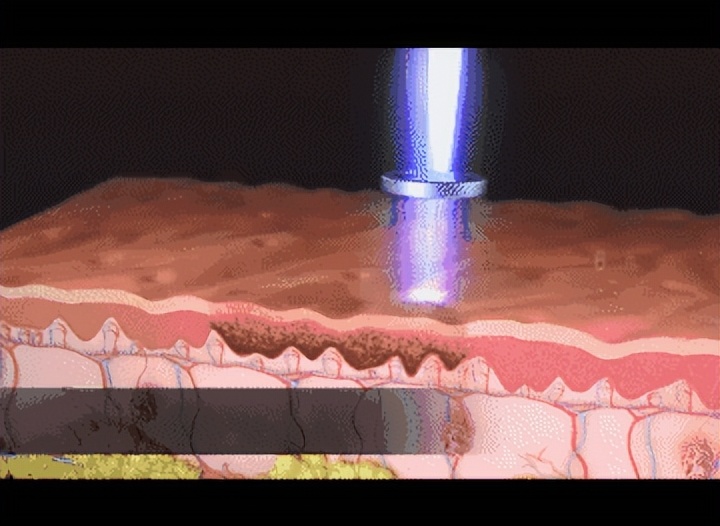 缩小毛孔7个实用方法小技巧,缩小毛孔的最好方法