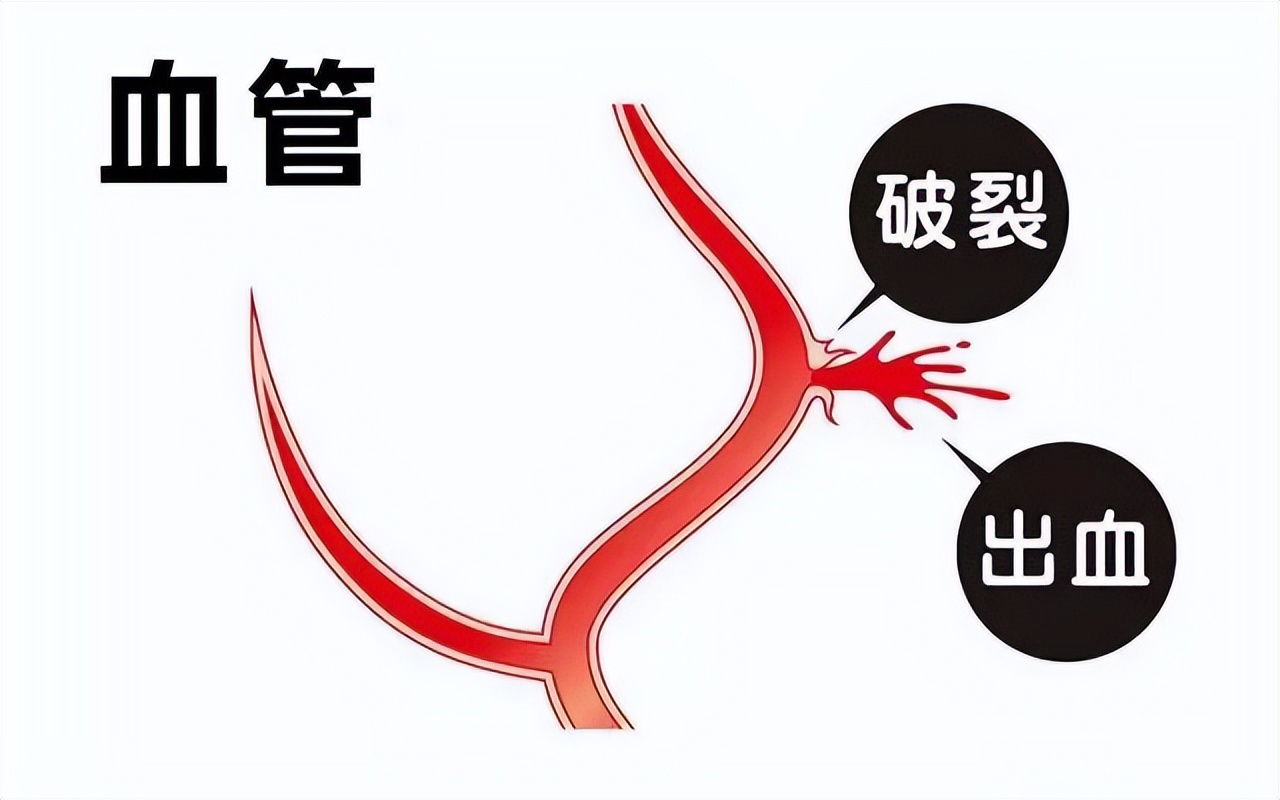 吻痕是不是出轨的证据,老公身上有吻痕可作为出轨证据吗