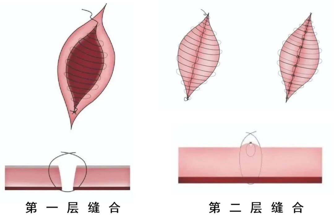 剖宫产从麻醉到伤口缝合需要多久,剖宫产伤口渗血渗液要再次缝合吗