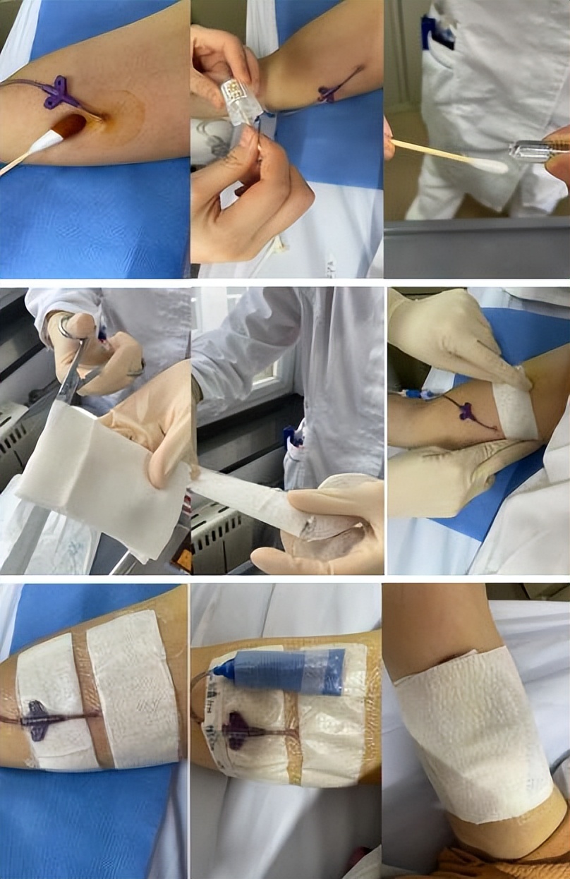 picc贴膜过敏怎么办,picc贴膜下皮肤起红疹原因