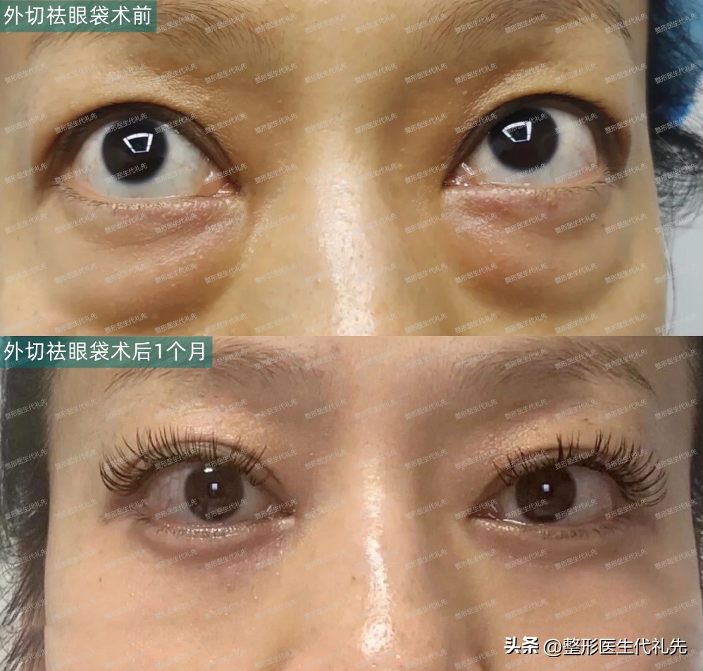 眼袋形成的真正原因,眼袋是怎么形成的去除眼袋的方法