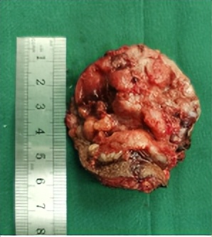 门医技术|区医院妇科成功完成三例复发性外阴恶性肿瘤切除手术