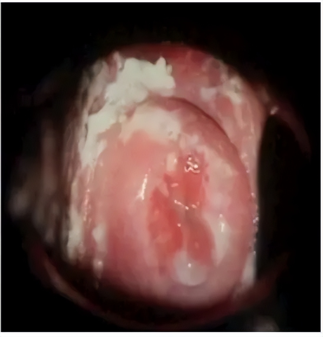 孕期阴道炎最好的治疗方法,孕期阴道炎有什么妙招