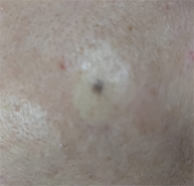 脸上的痣可以点掉吗,脸上有痣激光去痣好还是药水点好