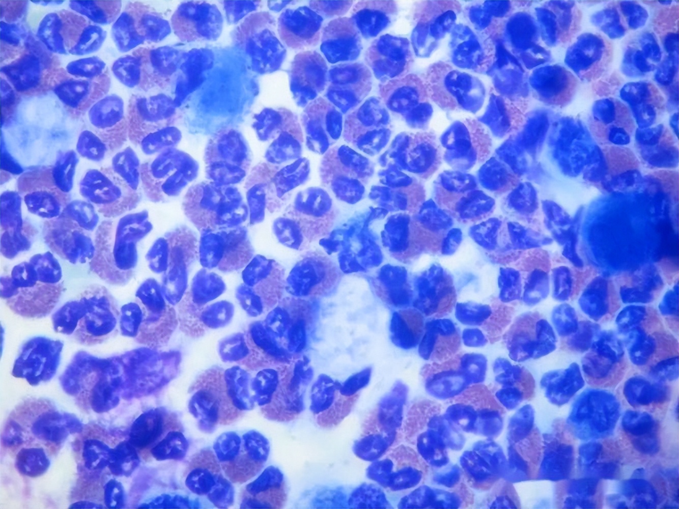 血常规炎性指标明显升高,新生儿血常规各项指标升高