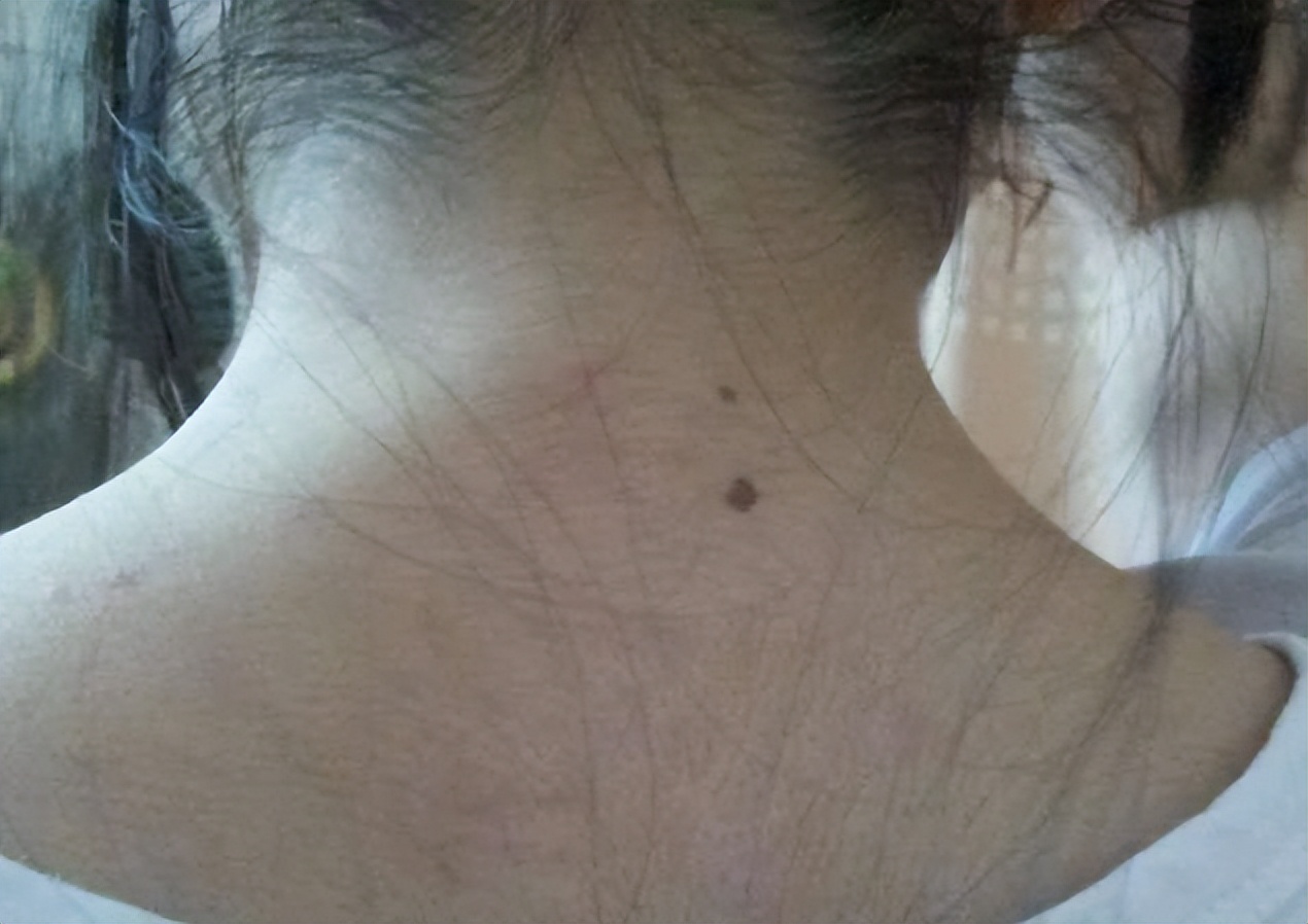黑痣发生这些变化时要警惕,医生长在摩擦部位的黑痣要当心