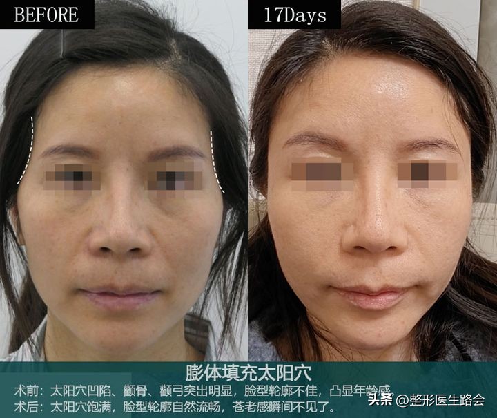 太阳穴做了填充手术第7天,填充太阳穴手术经历