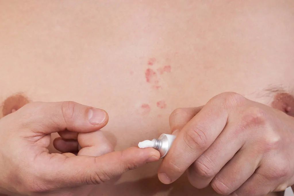 什么是湿疹湿疹是如何产生的,湿疹是什么原因造成的湿疹怎么治