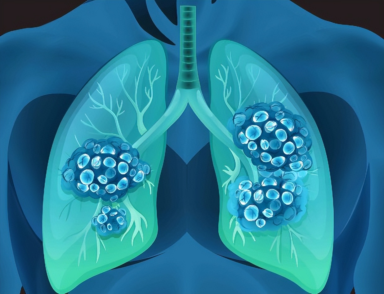 肩胛骨后背疼可能是肺癌吗,后背肩胛骨持续疼痛是肺癌吗