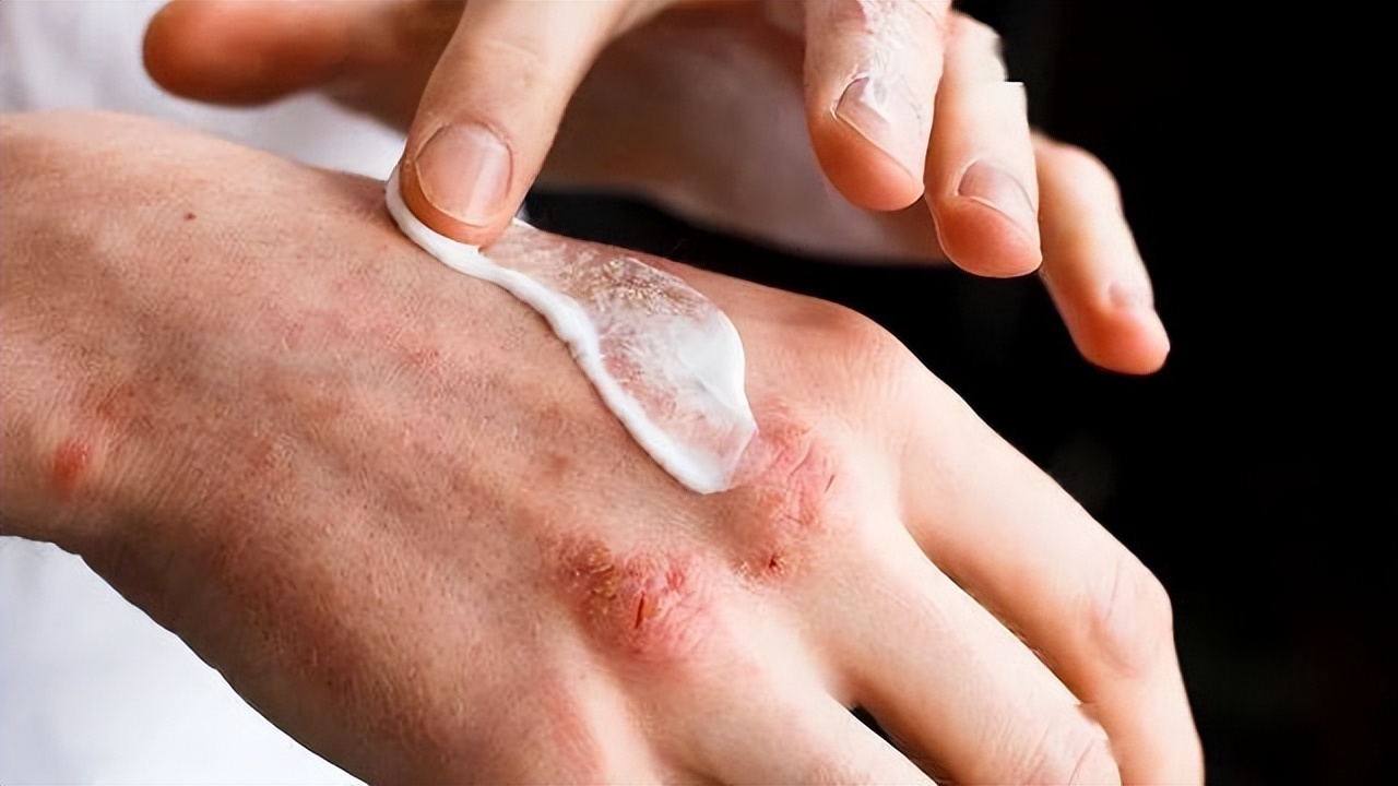 手脱皮如何判断是缺维生素还是癣,手脱皮是不痒是感染了癣吗