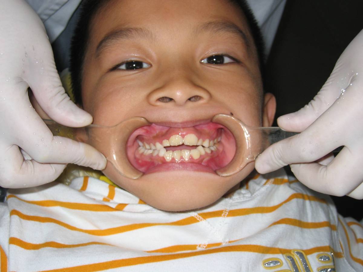 徐州儿童牙齿矫正牙齿不齐,大连口腔医院儿童牙齿矫正怎么样