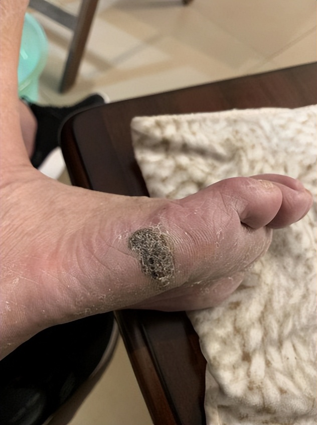 黑痣和黑色素沉着有何区别,什么样的黑痣要警惕可能会恶变