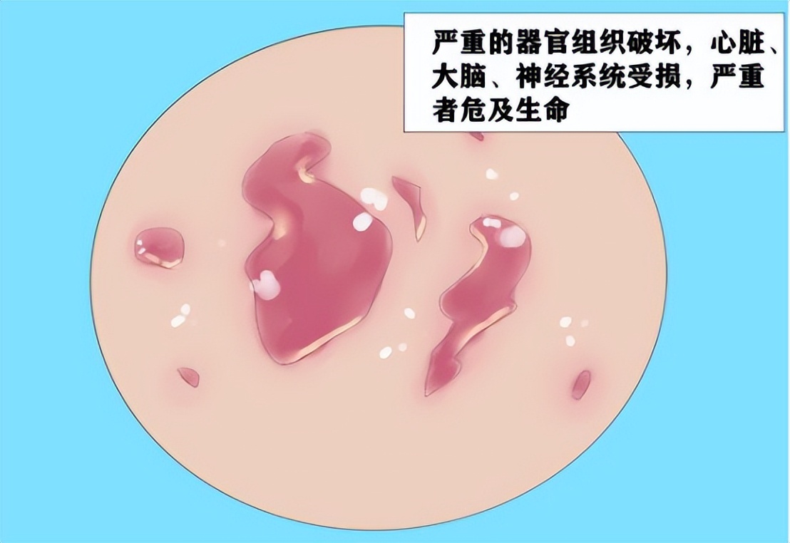 梅毒一旦感染终身携带,梅毒为什么会被终身标记