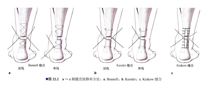 跟腱断裂对运动员的影响,运动员跟腱疼痛怎么解决