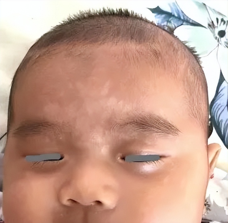 汗斑跟痱子怎么区分,汗斑传染给小孩子吗