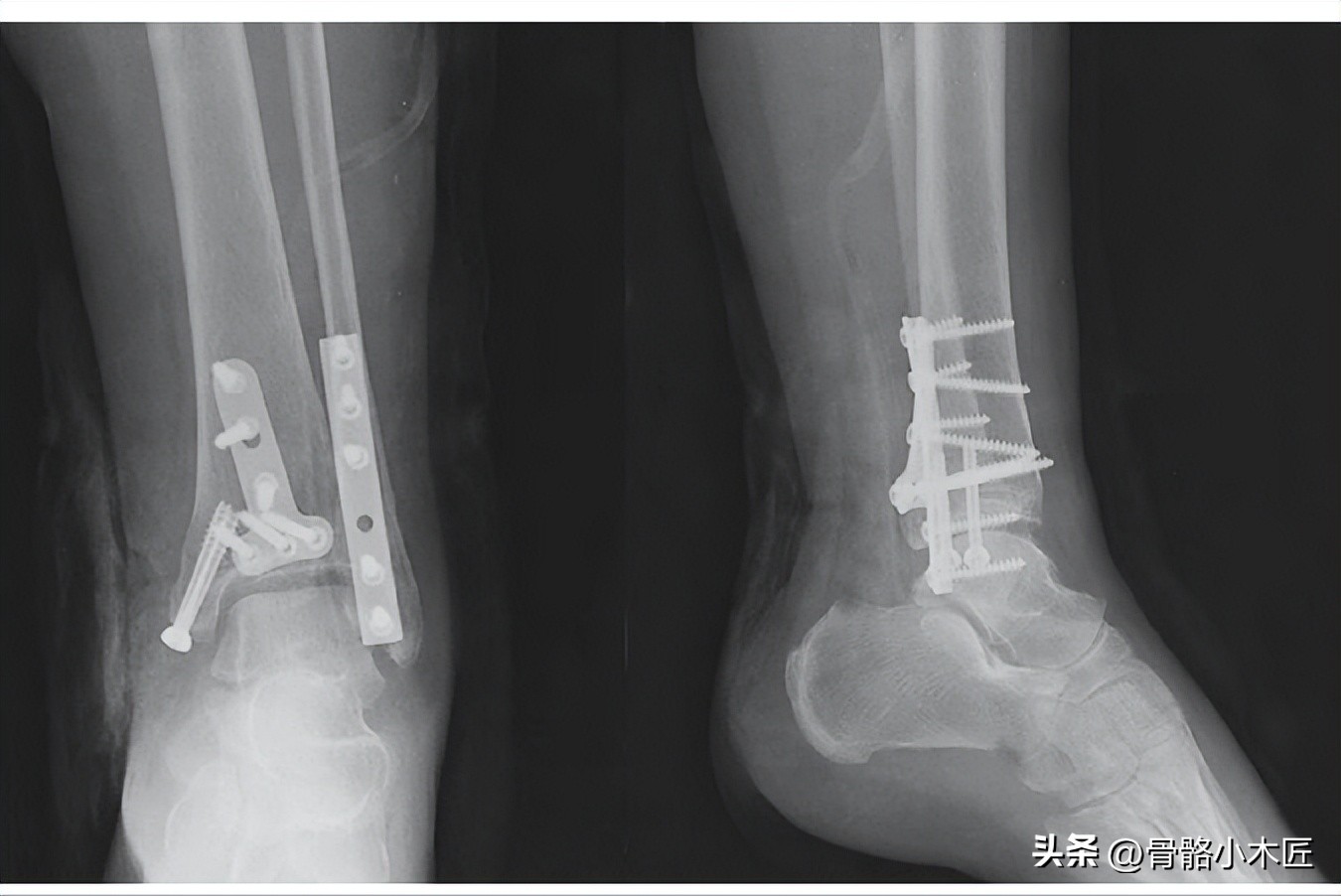 踝部骨折属于几级伤残,踝部骨折多久可以下地