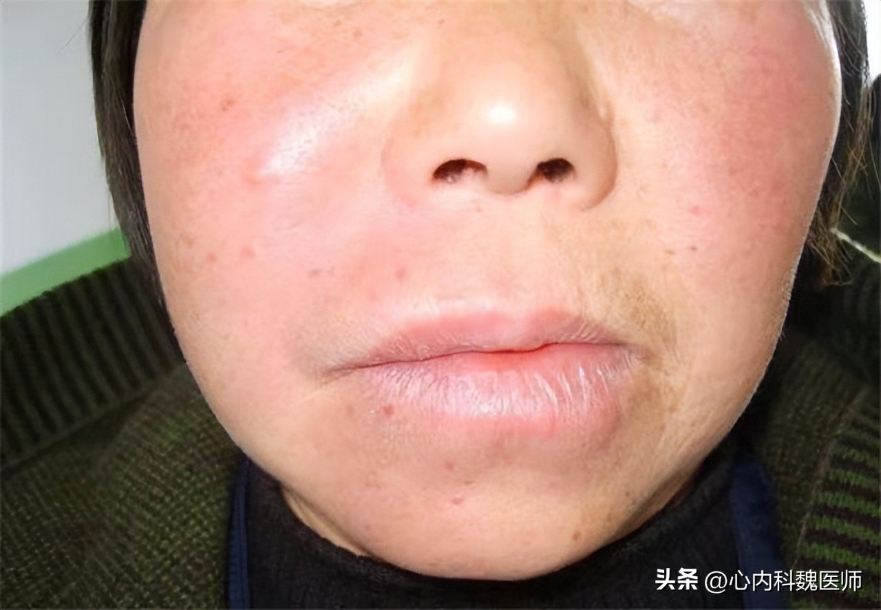 两种降压新药可保护心肾,心脑血管疾病用哪种降压药好