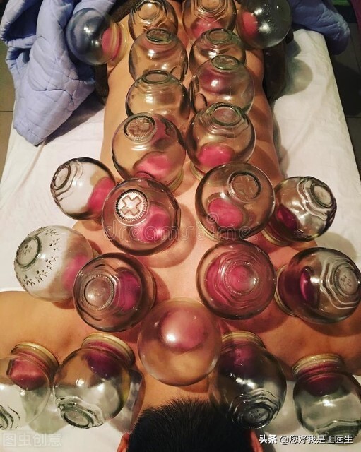 脖子疼怎么拔罐,脖子痛拔罐哪几个地方最好啊