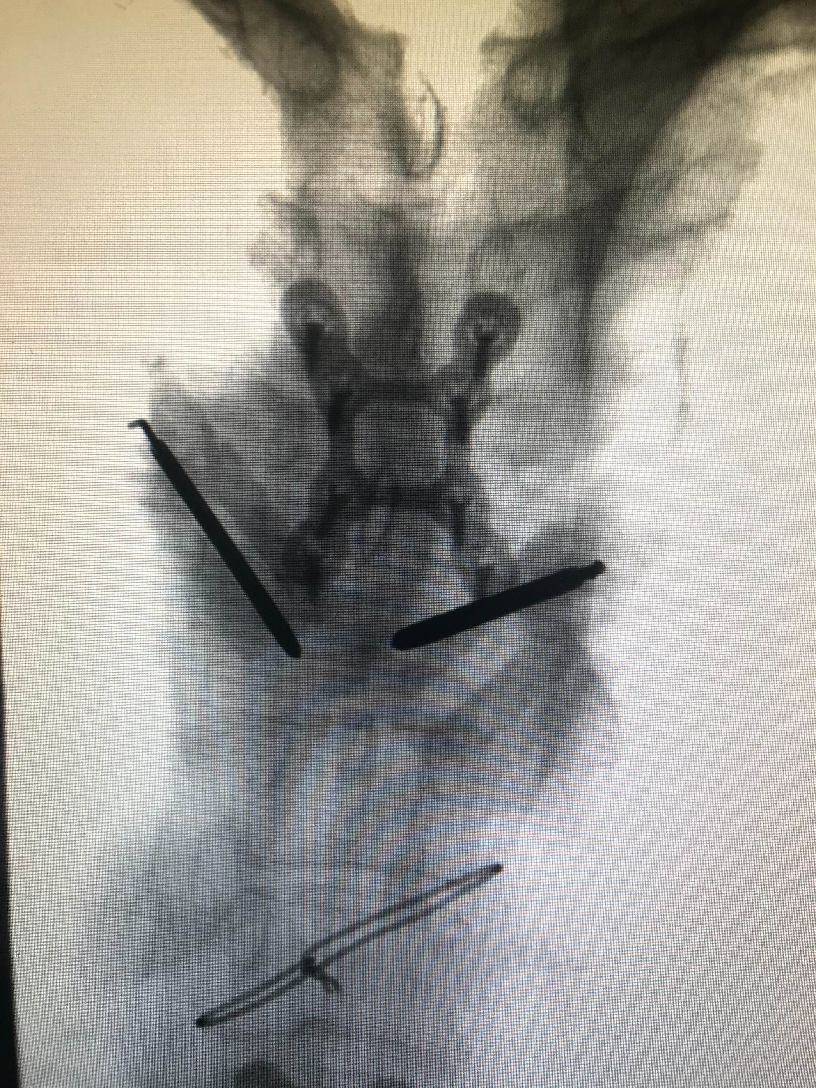 胸椎压缩性骨折微创手术利弊,胸椎压缩性骨折保守治疗20例