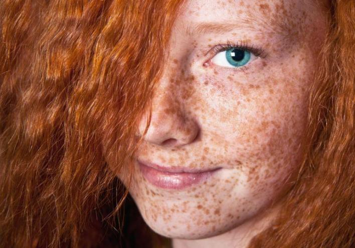 长在什么位置的痣易癌变,身上的痣出现4个变化引起重视