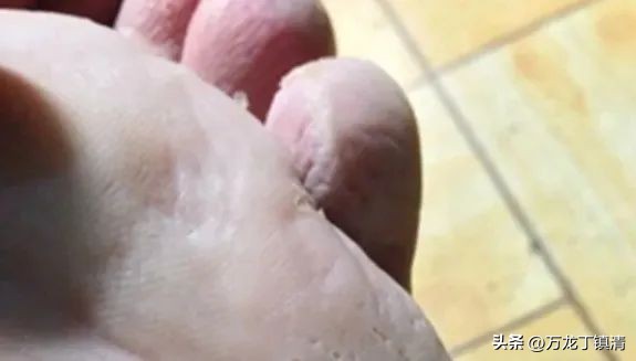 丁镇清从中西角度分析如何简单有效根治脚气病？