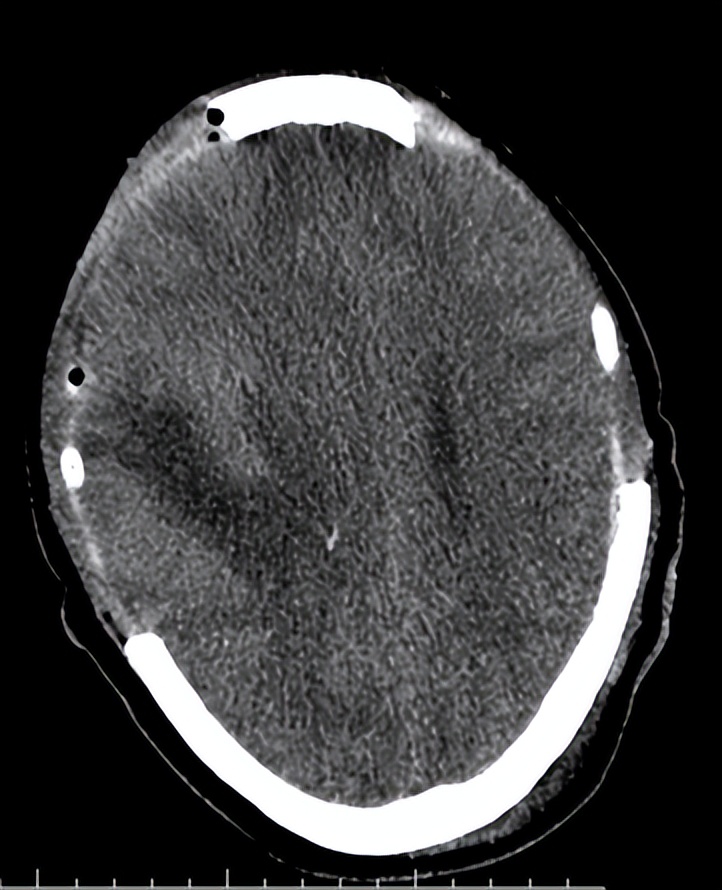 医院成功救治重型颅脑患者,特重型颅脑损伤治愈案