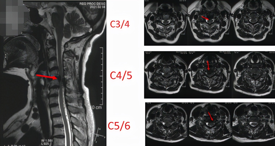 养花达人遇上右臂疼痛，原来是神经根型颈椎病在作祟