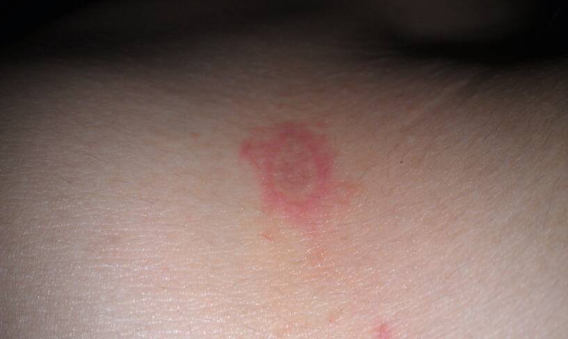 别把股癣当做“性病”！两者都有哪些区别，如何治疗？医生教你