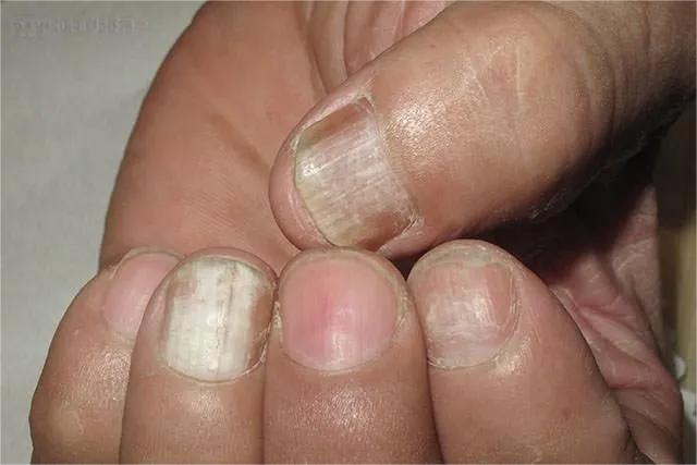 甲癣不严重怎么治疗,甲易生治疗灰指甲吗