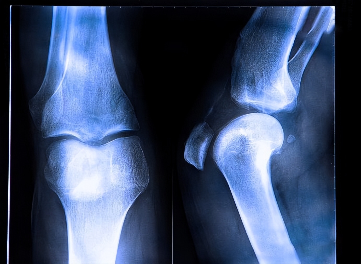 膝盖吱嘎吱嘎响有细微震动,膝盖噼啪响伴有疼痛