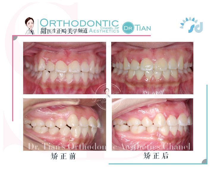 凸嘴下巴后缩拔牙改善有什么坏处,深覆合嘴凸下巴后缩矫正要拔牙吗