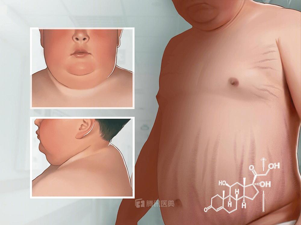 不同部位胖的原因及表现,身体哪个部位胖最不好