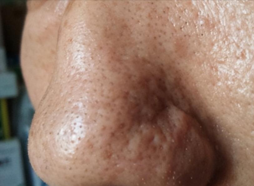 去鼻子上的黑头最好的方法,去鼻子上黑头的有效方法