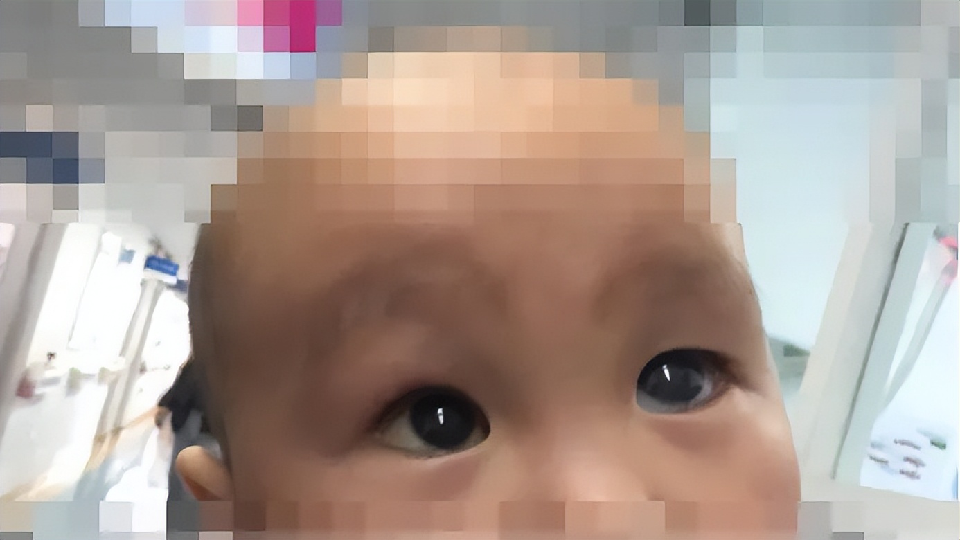 lowe综合征,继发性青光眼临床症状