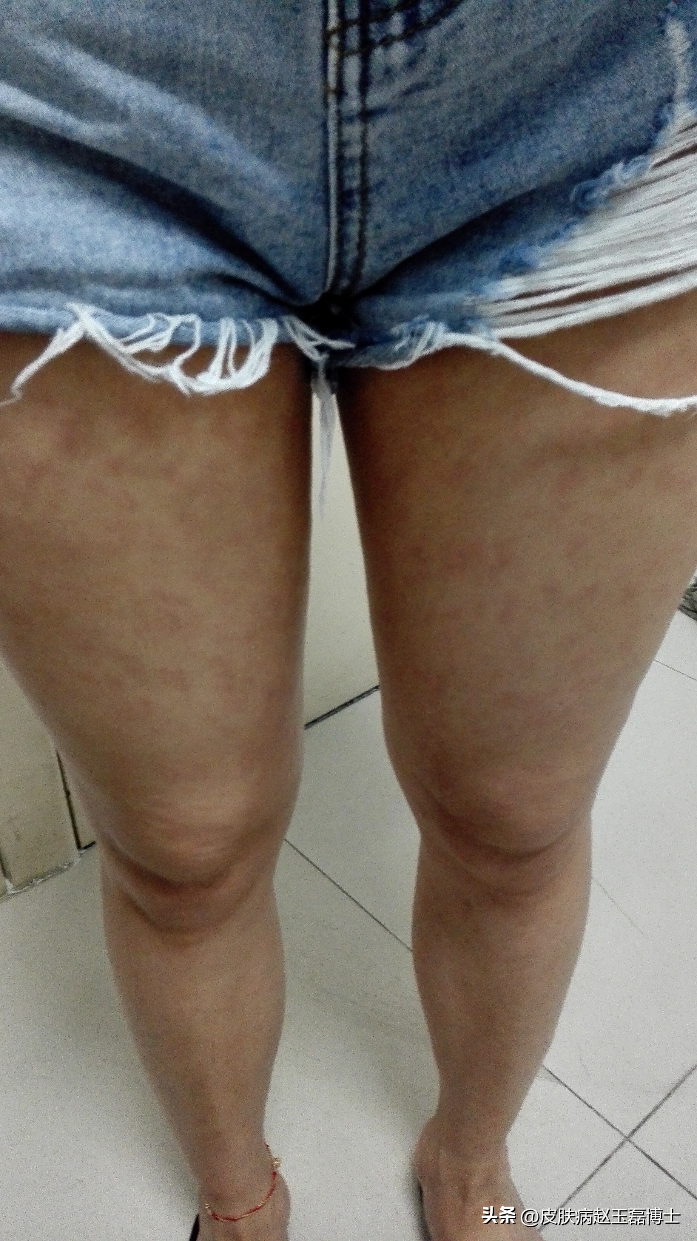 皮肤过敏竟被误诊为梅毒,身上出现梅毒疹