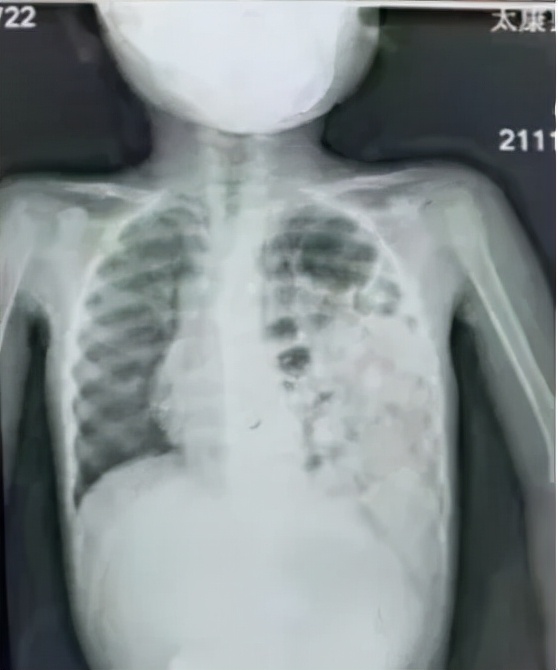 5岁儿童胃炎还胀气咕噜响怎么办,四岁孩子偶尔说胃和食管交界处疼