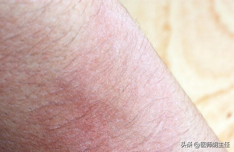 湿疹和荨麻疹汗疱疹同时出现吗,汗疱疹后期干裂瘙痒用什么药