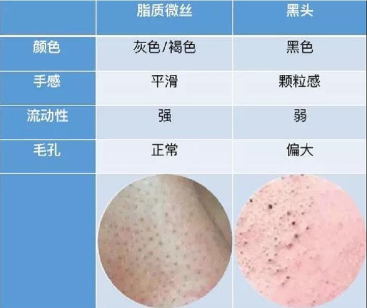 看不爽的黑头要这样对付它(二)方法篇
