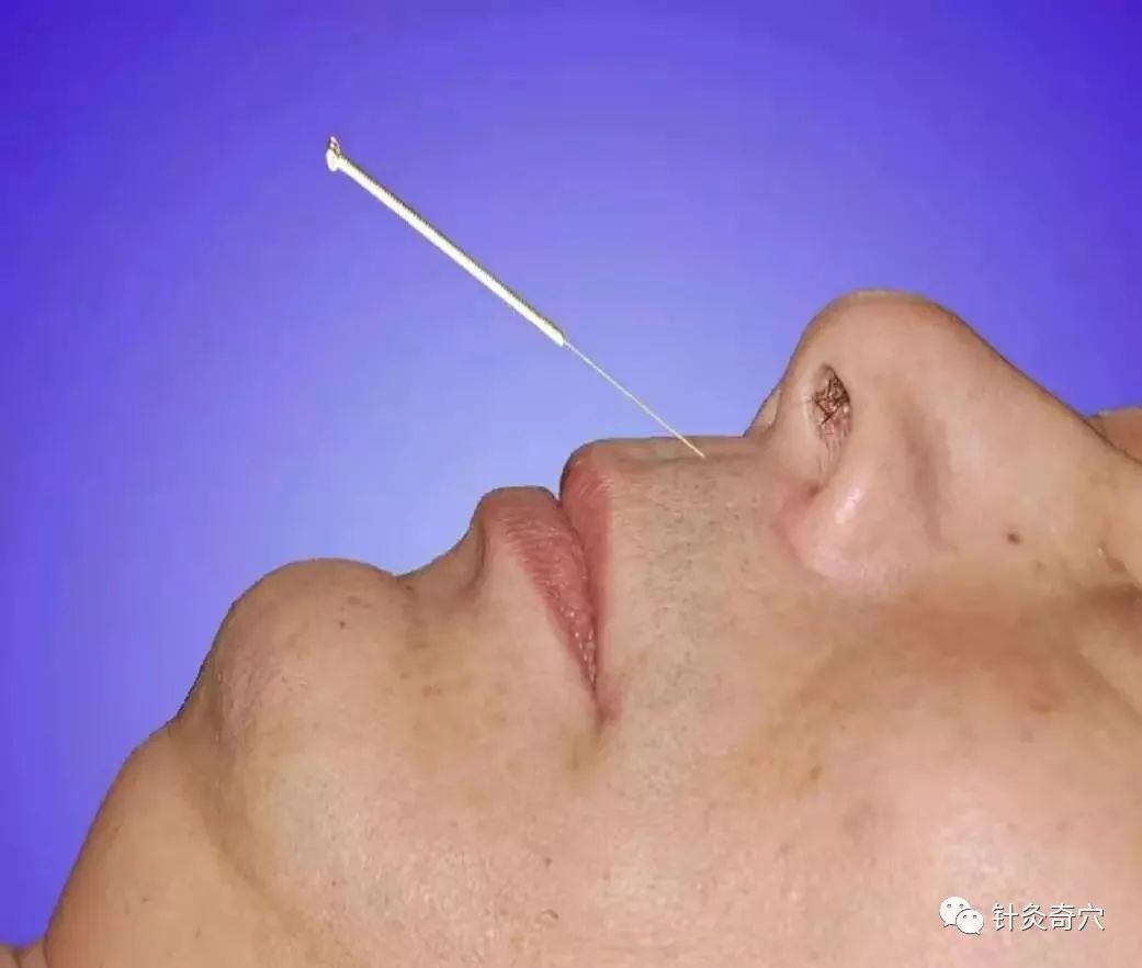 史上最全中医针灸视频教程全集,针灸治疗真实图片大全