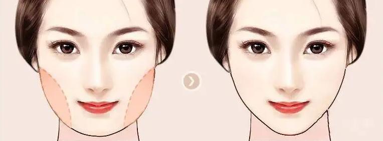 九院韦敏面部吸脂,九院韦敏植骨手术案例