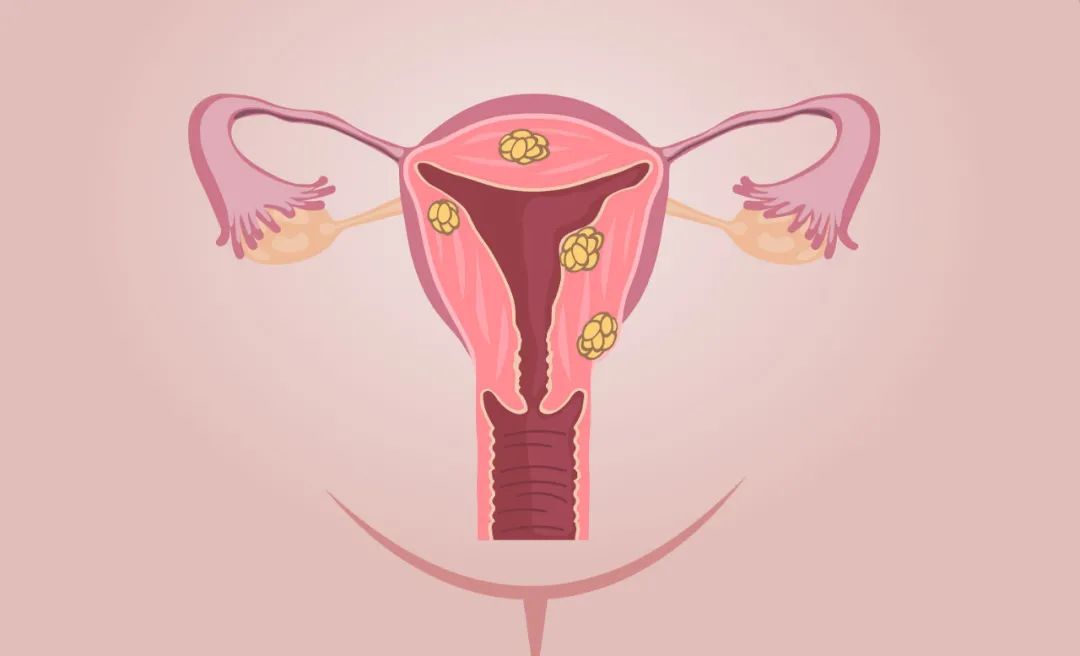 子宫肌瘤很多像葡萄串一样好不好,子宫肌瘤像一串葡萄一样