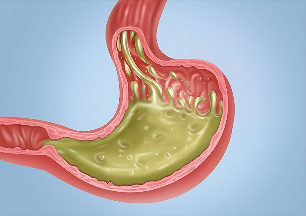 老年人胃食管反流怎么治,老人胃食管反流怎么治